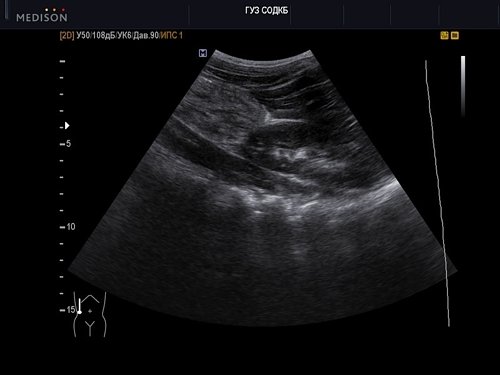 Инвагинат - эхограмма брюшной полости (B-режим), конвексный датчик 2-6 МГц