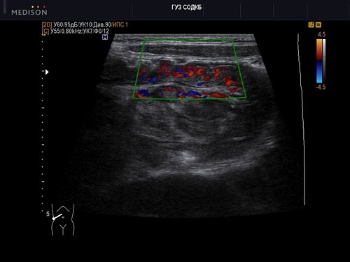 Инвагинат - эхограмма брюшной полости (режим B+ЦДК), линейный датчик 5-13 МГц