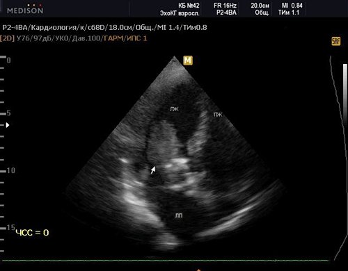 Эхограмма - флотирующая миксома левого предсердия
