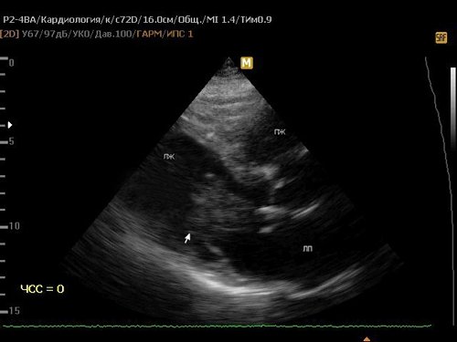 Эхограмма - флотирующая миксома левого предсердия (1)