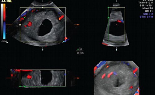 Эхограмма - обедненный кровоток по периферии образования и единичный сосуд, подходящий к плодному яйцу (мультипланарный режим 3D и ЦДК)