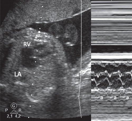 Эхокардиография плода (М-режим) - определение соответствия сокращений предсердий и желудочков (RV-правый желудочек, LA - левое предсердие)