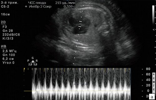 Суправентрикулярная тахикардия при отсутствии структурной кардиальной патологии (беременность 35 недель, ЧСС 215 уд/мин)