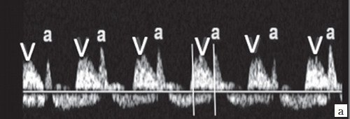 Одновременная артериально-венозная импульсно-волновая допплерография восходящей аорты и верхней полой вены (короткий интервал VA)