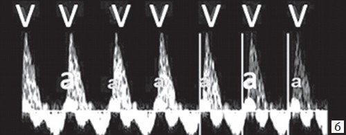 Одновременная артериально-венозная импульсно-волновая допплерография восходящей аорты и верхней полой вены (длинный интервал VA)