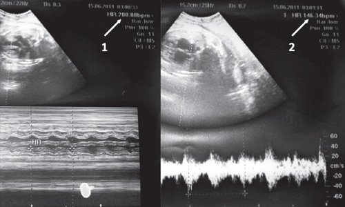 Идиопатическая вентрикулярная тахикардия плода (беременность 39 недель)
