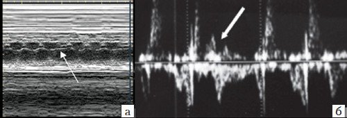 Нерегулярный сердечный ритм плода: а - предсердная экстрасистола, б - желудочковая экстрасистола
