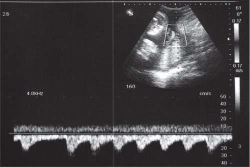 Транзиторная доброкачественная брадикардия (асистолия плода) на этапе II триместра беременности
