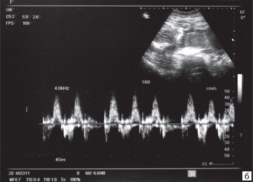 Импульсно-волновая допплерография - регистрация сокращений предсердий при предсердной тригеминии (беременность 35 недель)