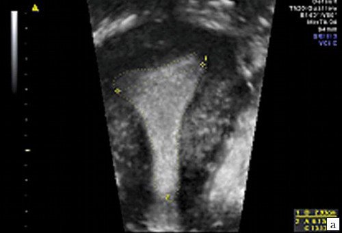Эхограмма - полость матки правильной треугольной формы, после консервативной миомэктомии (а)