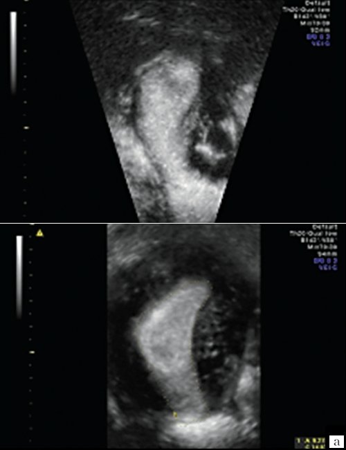 Эхограмма - деформация полости матки в области трубных углов (после консервативной миомэктомии)