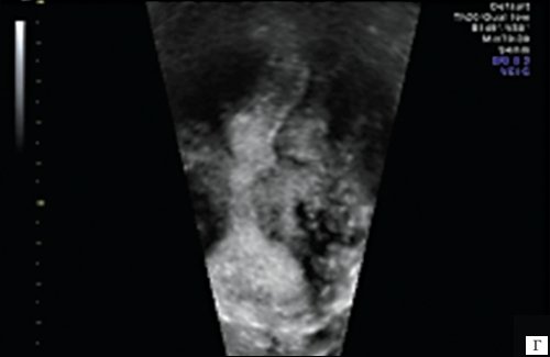 Эхограмма - выраженная деформация всех отделов полости матки с частичной ее облитерацией (после консервативной миомэктомии)