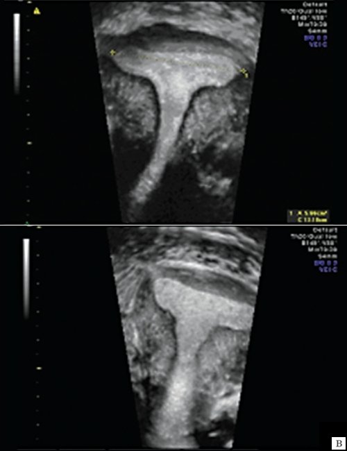Эхограмма - T-образная форма полости матки (после консервативной миомэктомии)