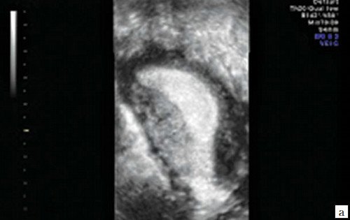 Эхограмма - продолговатая форма полости матки, расширение истмического отдела (а)