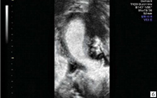 Эхограмма - продолговатая форма полости матки, расширение истмического отдела (б)