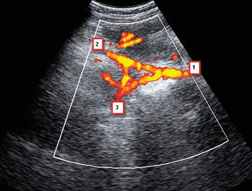 Бифуркация общей подвздошной артерии (режим ЦДК): 1 - общая подвздошная артерия, 2 - наружная подвздошная артерия, 3 - внутренняя подвздошная артерия