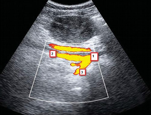 Бифуркация общей подвздошной артерии после перевязки ВПА (режим ЦДК): 1 - общая подвздошная артерия, 2 - наружная подвздошная артерия, 3 - кровоток во ВПА ниже места перевязки не определяется