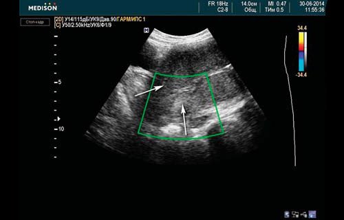 Эхограмма (режим ЦДК) - кровоток в левом сосудистом пучке матки не определяется (1-е сутки после перевязки внутренних подвздошных артерий)
