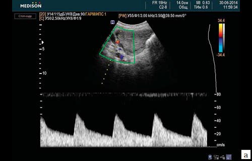 Спектрограмма скоростей кровотока в a. uterine dextra (3-и сутки после перевязки внутренних подвздошных артерий