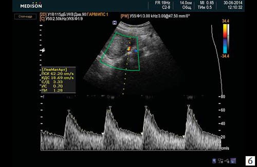 Спектрограмма скоростей кровотока в a. uterine sinistra (3-и сутки после перевязки внутренних подвздошных артерий)