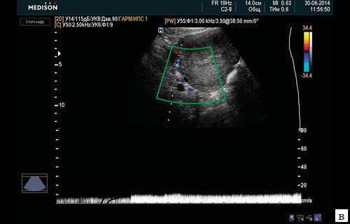 Спектрограмма скоростей кровотока в v. uterine dextra (3-и сутки после перевязки внутренних подвздошных артерий)