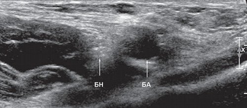 Эхограмма (В-режим) правого бедренного нерва в поперечной плоскости сканирования на уровне паховой области (БН - бедренный нерв, БА - бедренная артерия)