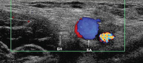 Эхограмма (режим ЦДК) правого бедренного нерва в поперечной плоскости сканирования на уровне паховой области (БН - бедренный нерв, БА - бедренная артерия)