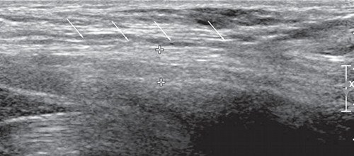Эхограмма (В-режим) правого бедренного нерва в продольной плоскости сканирования на уровне паховой области и верхней трети бедра (стрелки - бедренный нерв)