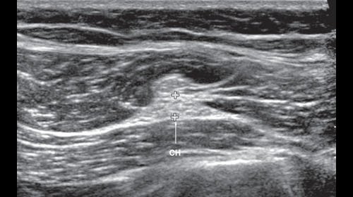 Эхограмма (В-режим) левого седалищного нерва в поперечной плоскости сканирования в верхней трети задней поверхности бедра (СН - седалищный нерв)