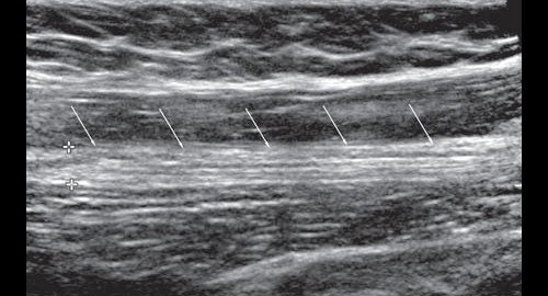 Эхограмма (В-режим) левого седалищного нерва в продольной плоскости сканирования в верхней трети задней поверхности бедра (стрелки - седалищный нерв)