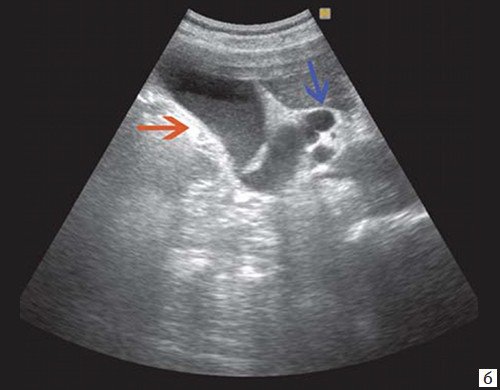 Эхограмма низкого печеночного блока, обусловленного опухолью головки ПЖ - увеличенный желчный пузырь с густой взвесью (красная стрелка) и расширенный ОЖП (синяя стрелка)