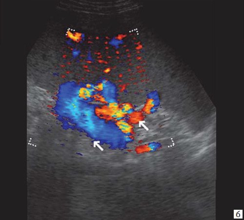 Эхограмма портальных коллатералей воротной вены (режим ЦДК) - выраженные крупные коллатерали в проекции воротной вены