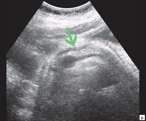 Эхограмма опухоли большого дуоденального сосочка - расширение панкреатического протока (зеленая стрелка)