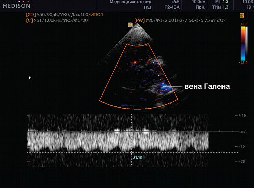 Эхограмма (режим ЦДК и PW) - вена Галена (большая вена мозга), cканирование потока в вене Галлена