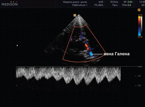 Эхограмма (режим ЦДК и PW) - прямой синус, сканирование патологического ускоренного потока в вене Гален