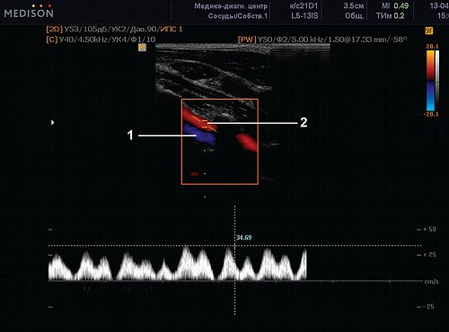 Эхограмма (режим ЦДК и PW) - ветвь задней мозговой артерии (левая), продольное сканирование в проекции сегмента V2 позвоночной артерии (1) и позвоночной вены (2)
