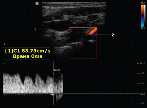 Эхограмма (режим ЦДК и PW) - вена Розенталя (левая), продольное сканирование в проекции сегмента V1 позвоночной артерии (1), патологический ускоренный поток в позвоночной вене (2)