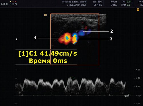 Эхограмма (режим ЦДК и PW) - нижняя желудочковая вена, поперечное сканирование в проекции внутренней сонной артерии (3), наружной сонной артерии (2) и внутренней яремной вены (1)