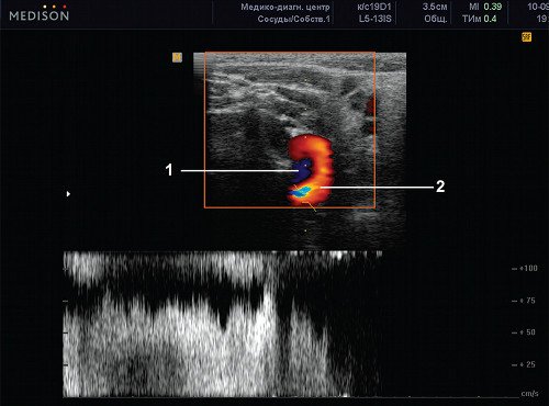 Эхограмма (режим ЦДК и PW) - поперечное сканирование в проекции внутренней сонной артерии (1) и извитой внутренней яремной вены (2), патологически ускоренный турбулентный поток во внутренней яремной вене