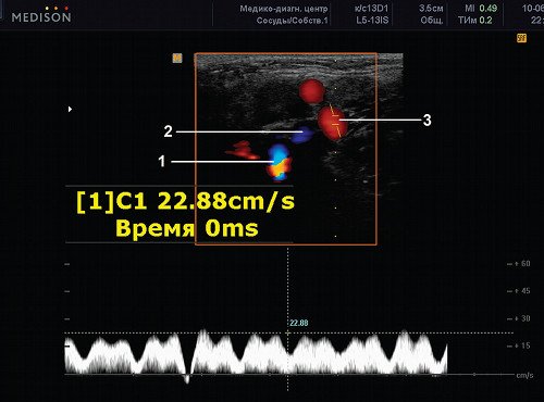 Эхограмма (режим ЦДК и PW) - поперечное сканирование в проекции внутренней (1) и наружной (2) сонных артерий, наружной яремной вены (3)