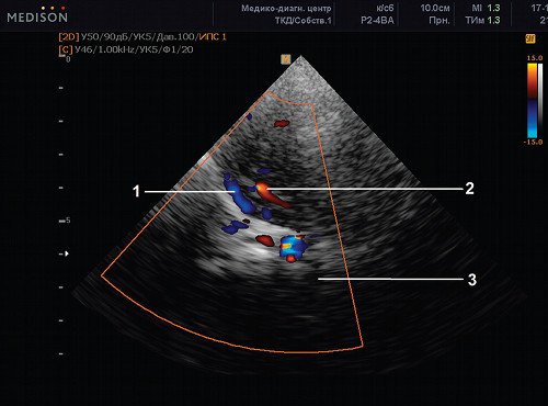 Эхограмма (режим ЦДК) - транстемпоральный доступ на уровне СМА (2) и клиновидно-теменного венозного синуса (1)
