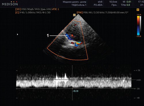 Эхограмма (режим ЦДК и PW) - сканирование потока в клиновидно-теменном венозном синусе (1)