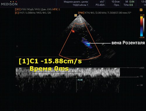Эхограмма (режим ЦДК и PW) - средняя мозговая вена (глубокая), сканирование потока в вене Розенталя