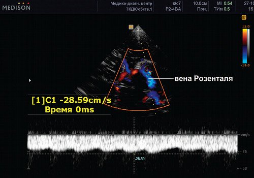 Эхограмма (режим ЦДК и PW) - задняя мозговая артерия (сегмент Р1), сканирование патологического ускоренного потока в вене Розенталя