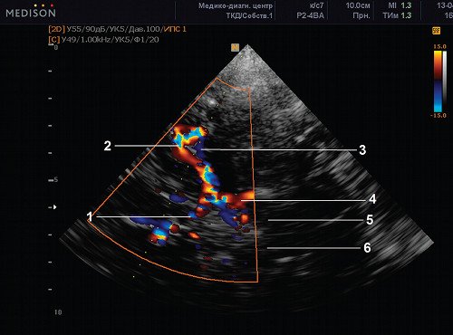 Эхограмма (режим ЦДК) - базилярная (основная) артерия, транстемпоральный доступ