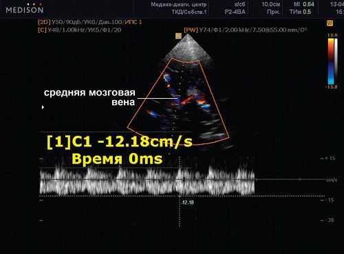 Эхограмма (режим ЦДК и PW) - вена Розенталя (правая) и ветвь задней мозговой артерии (правая), сканирование потока в средней мозговой вене