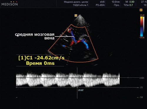 Эхограмма (режим ЦДК и PW) - позвоночная артерия (сегмент V1), сканирование патологического ускоренного потока в средней мозговой вене