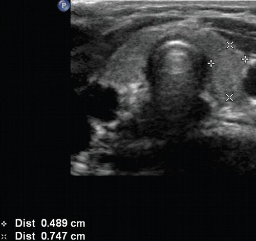 Эхограмма щитовидной железы при ее гипофункции у 5-летнего ребенка (объем железы уменьшен, эхоплотность повышена)