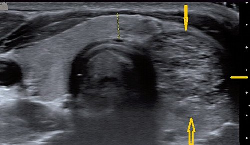 Эхограмма - аденоматозный узел, практически полностью заменивший долю щитовидной железы