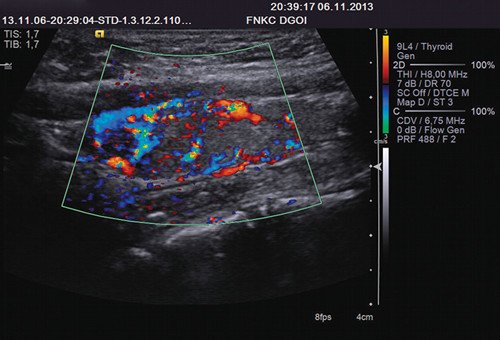 Эхограмма (режим ЦДК) - рак щитовидной железы (обильная васкуляризация)